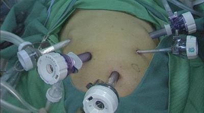 Analysis of the safety and efficacy of the self-pulling and latter transected technique in modified overlap anastomosis in total laparoscopic total gastrectomy